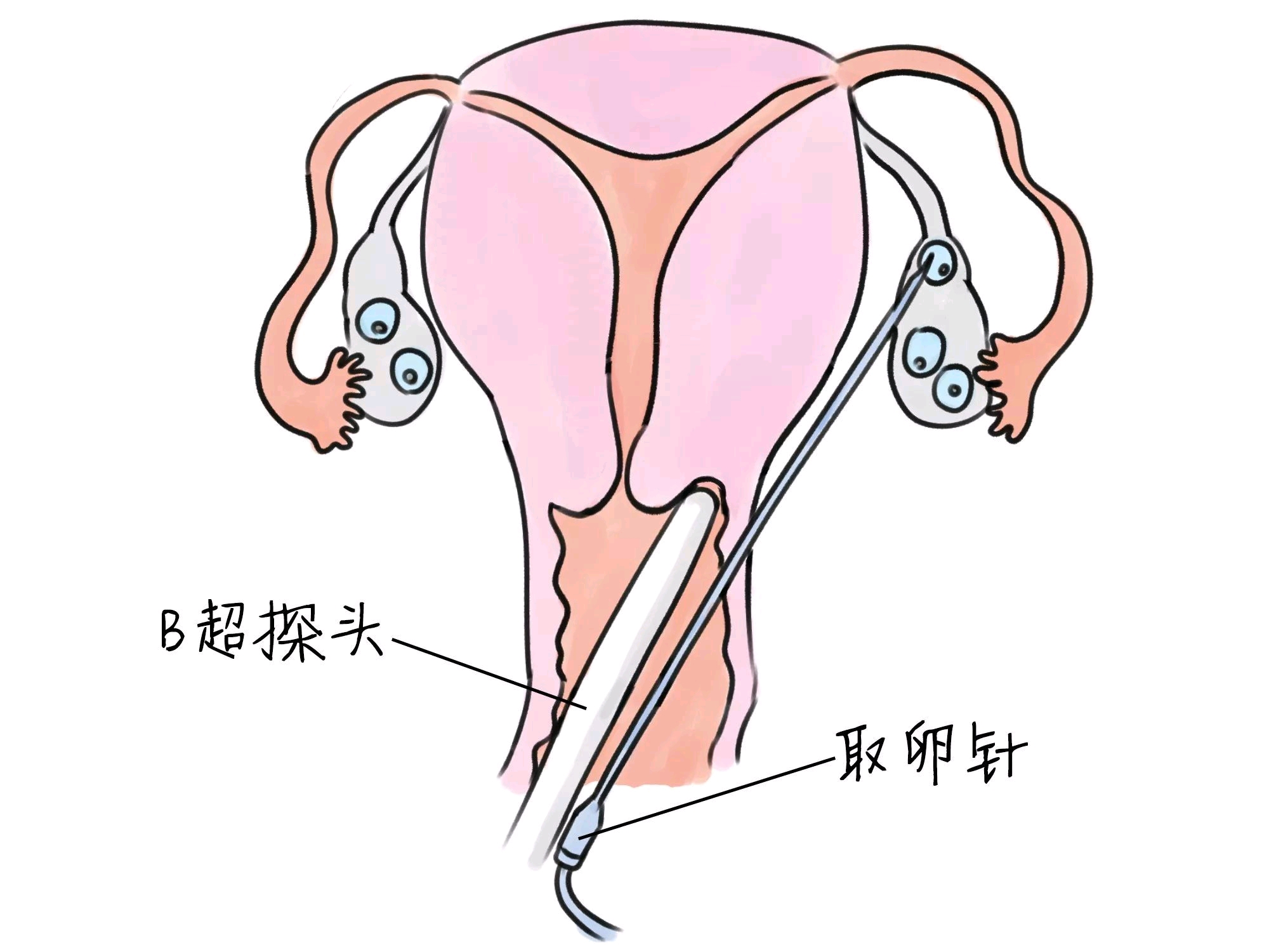 南宁三代试管婴儿